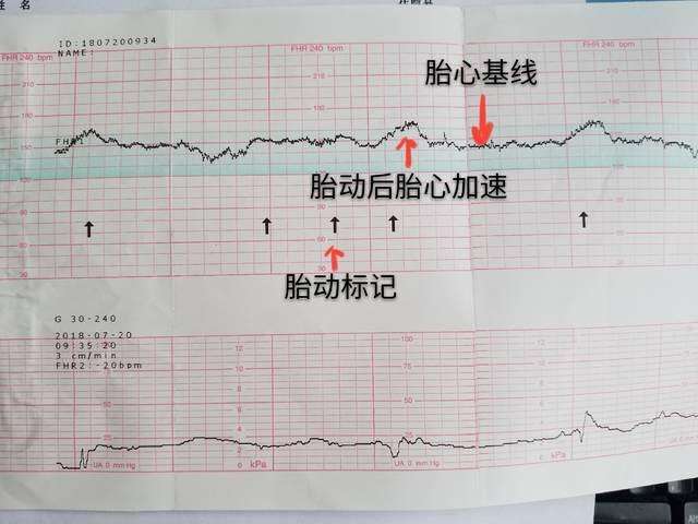 胎心监护的必要性是什么？这个时间和注意事项很重要，孕妇要知道