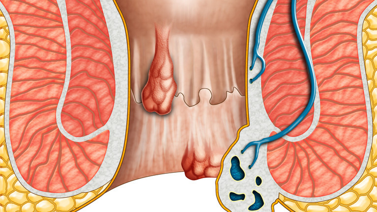 痔疮和息肉的区别