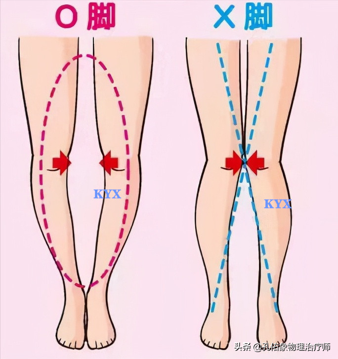 老年人下蹲、上下楼梯困难，膝关节疼痛，是膝关节骨性关节炎吗？