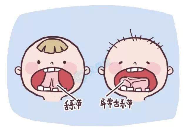 宝宝说话不利索,宝宝舌系带过短,要剪掉那跟筋吗?