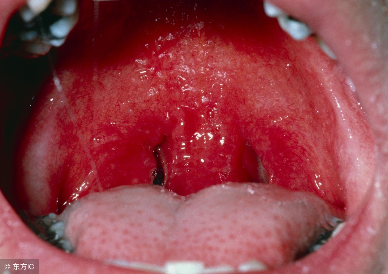 咽喉炎吃什么药好 咽炎的特效药 - 天云网