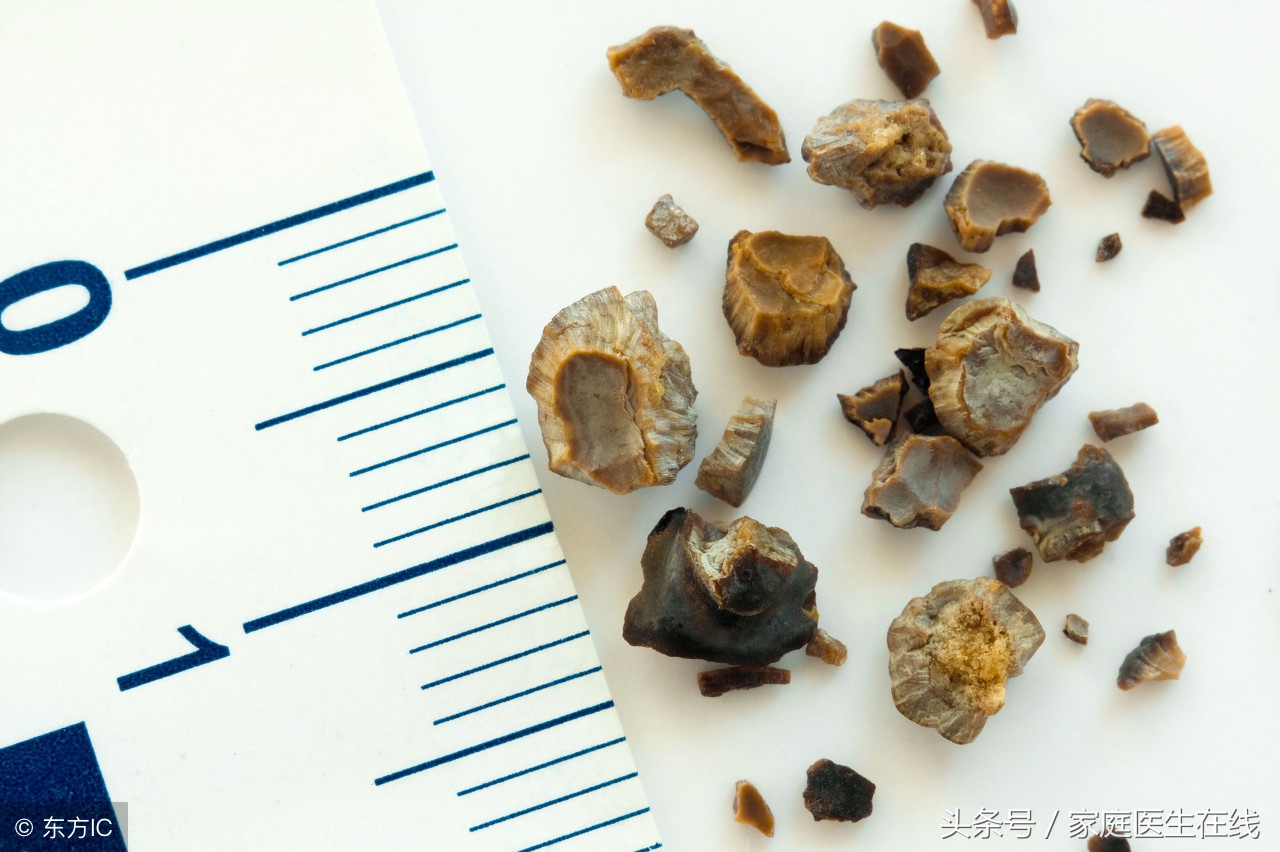 患上肾结石，一般有哪些治疗方式？医生指出这2种