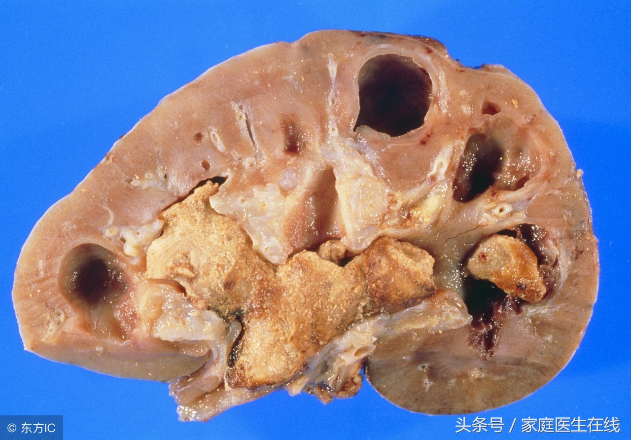 肾结石治疗方法与注意事项