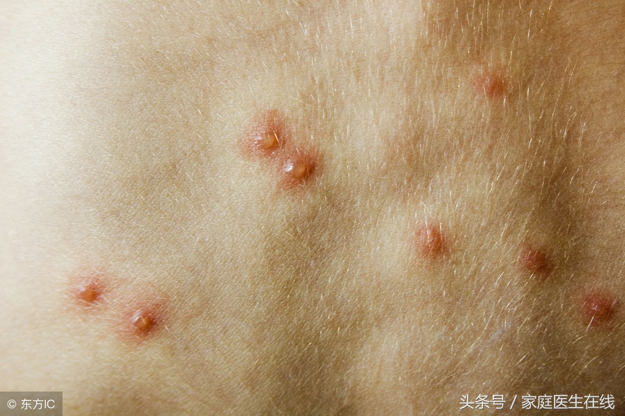 水痘通过什么方法传染,出水痘有什么土方法-友友