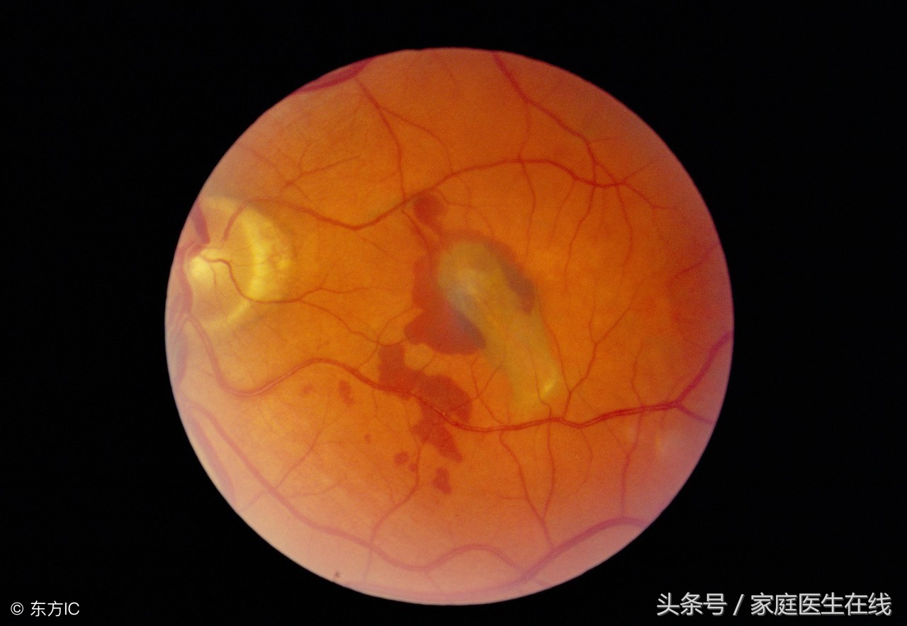 眼前出现黑色絮状漂浮物是啥毛病是这3个原因在作怪