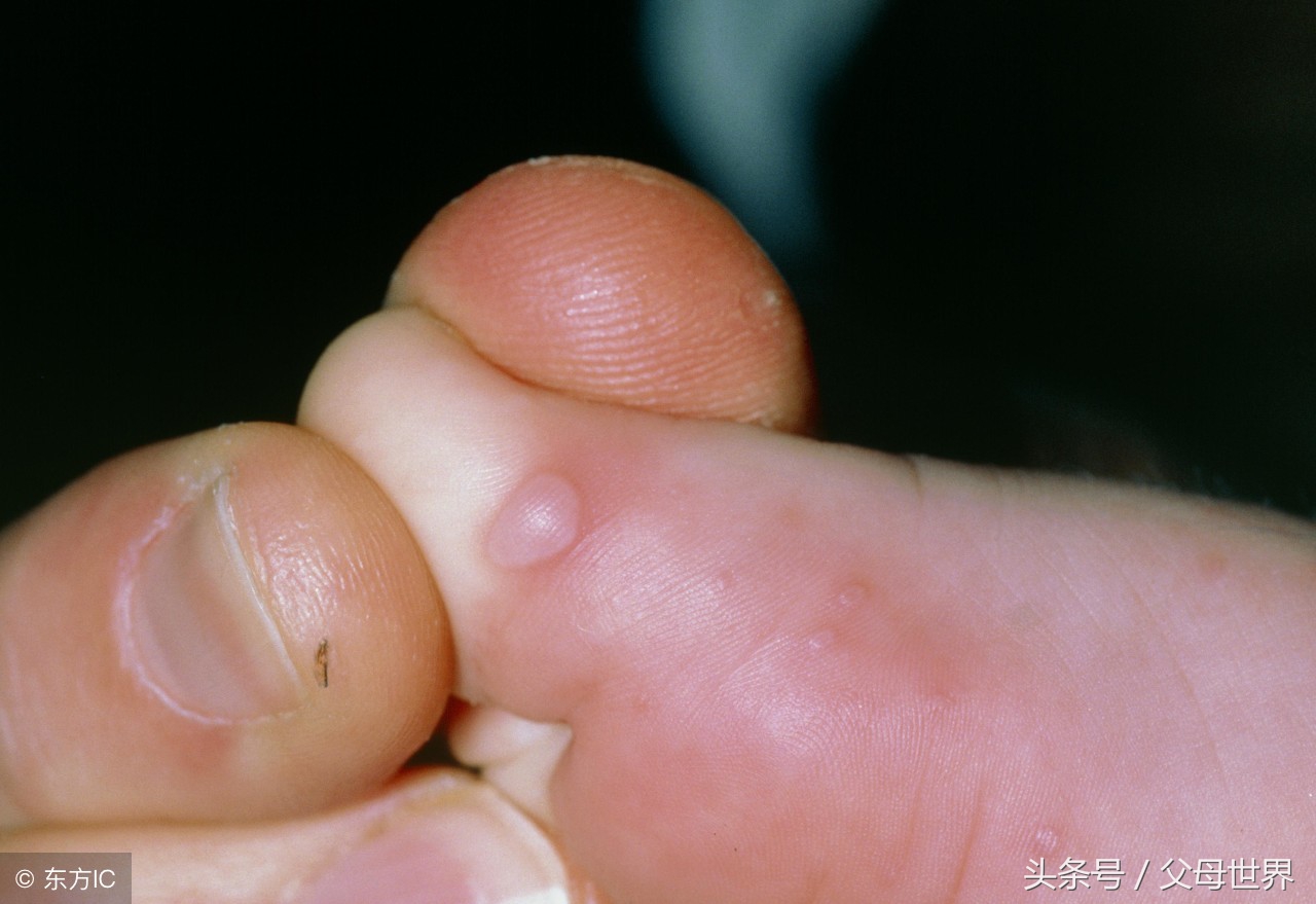 什么是手足口病?该怎样预防?中医专家教你7个方法,轻松应对!