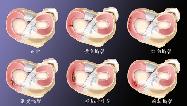 拿什么拯救你，我的半月板，保守还是手术？