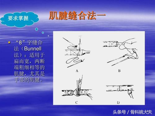 筋断了还能接上？接上了还能跟没受伤一样动？外科手术真神奇