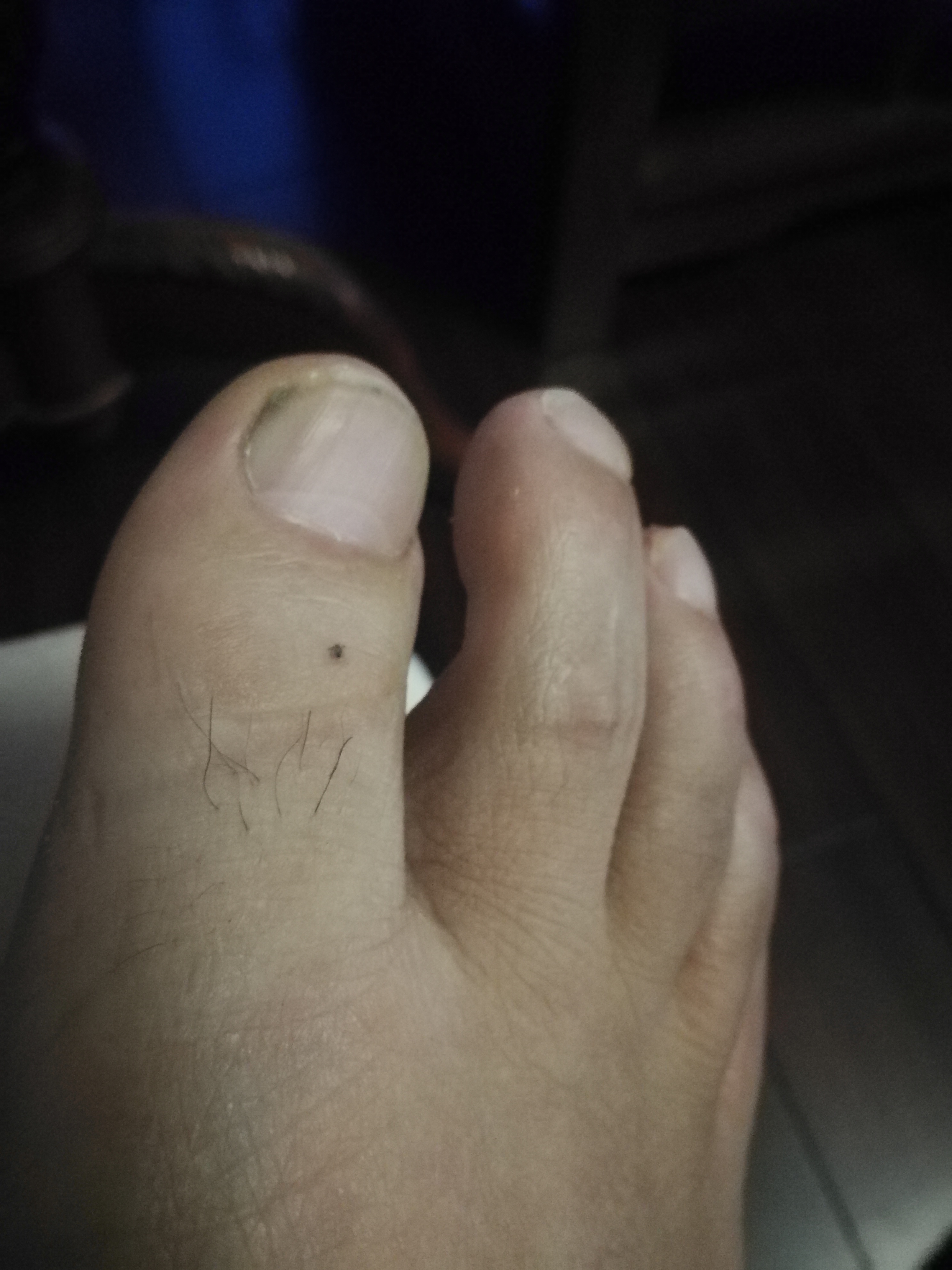 相术：图解——脚上长痣