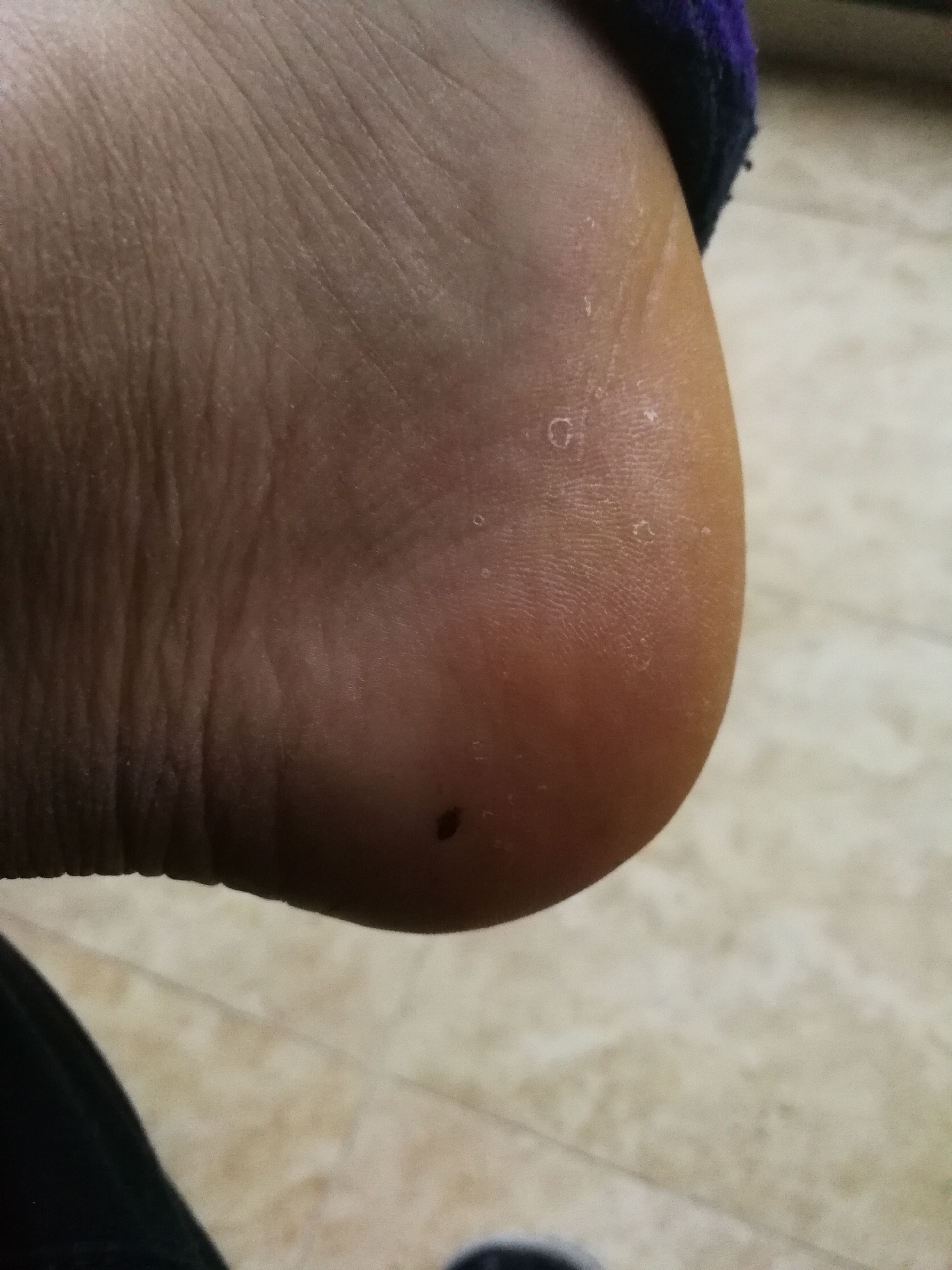 相术：图解——脚上长痣