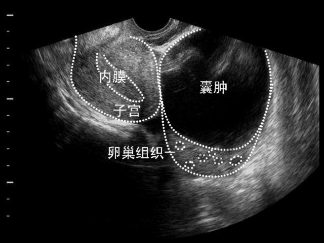 常见女性疾病，卵巢囊肿的诊断和治疗