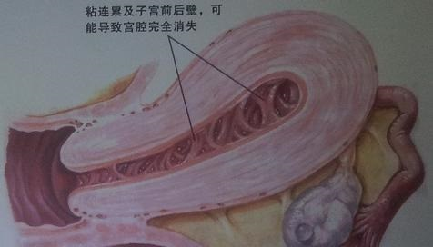 宫腔粘连可以做试管婴儿吗（子宫内膜损伤粘连）