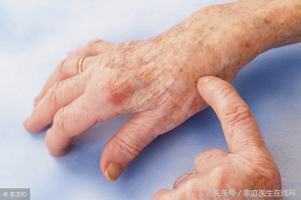 尿酸高有哪些症状表现(尿酸高) 第1张