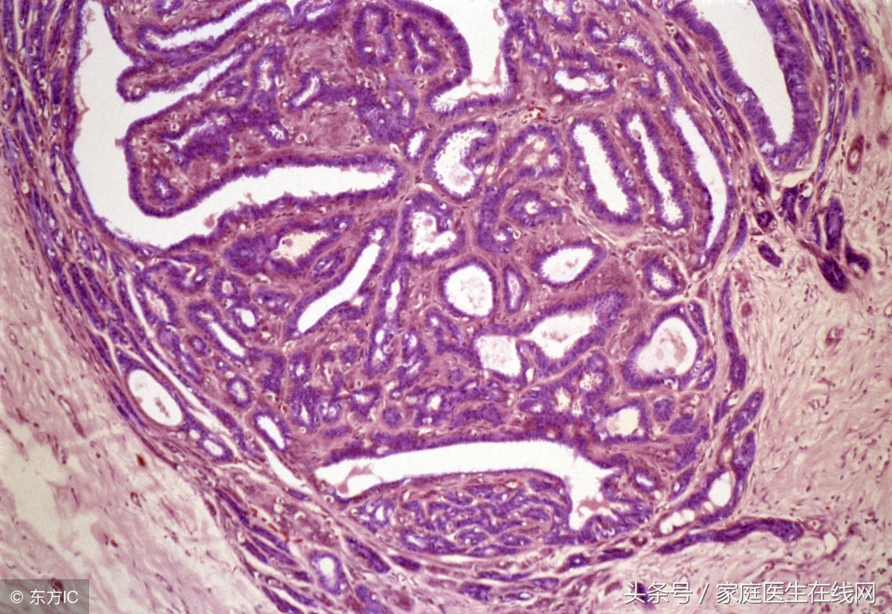 女性乳房出现硬块的常见原因及应对方法