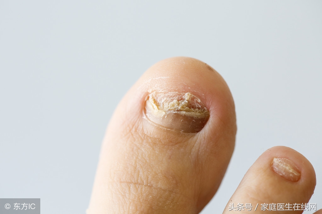 指甲容易分层该怎么治疗?这3个方法,供你选择