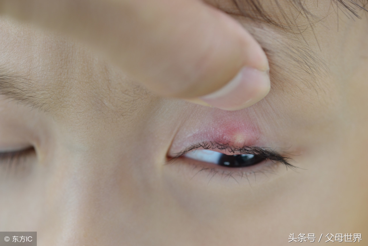 孩子长了针眼怎么办?不早点治疗可能变大病,家长一定要重视起来