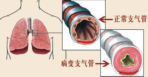 为什么我的孩子反复呼吸道感染？缘于家长忽略这个细节