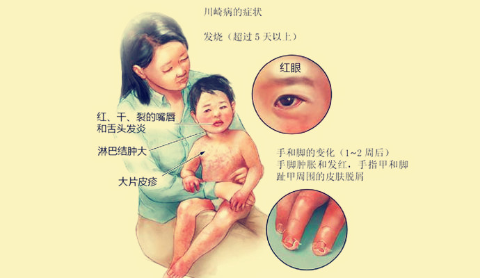 治疗川崎病需要多少钱(川崎病不可怕)