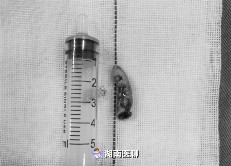 到医院检查,发现是左侧颌下腺导管里长了一个3公分的巨型结石,足有三