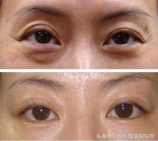 鱼尾纹面相之说,不可信!显老却是事实!