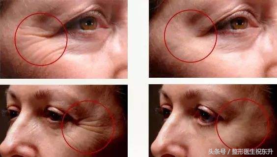 鱼尾纹面相之说,不可信!显老却是事实!