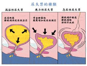 咳嗽、打喷嚏会漏尿怎么办？聊聊女性尿失禁