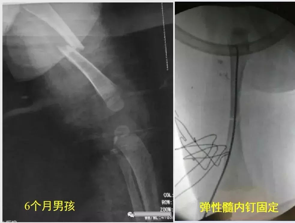 两个儿童股骨干骨折争议病例