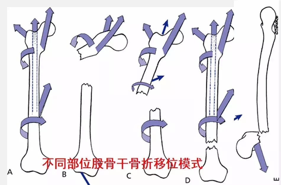 两个儿童股骨干骨折争议病例