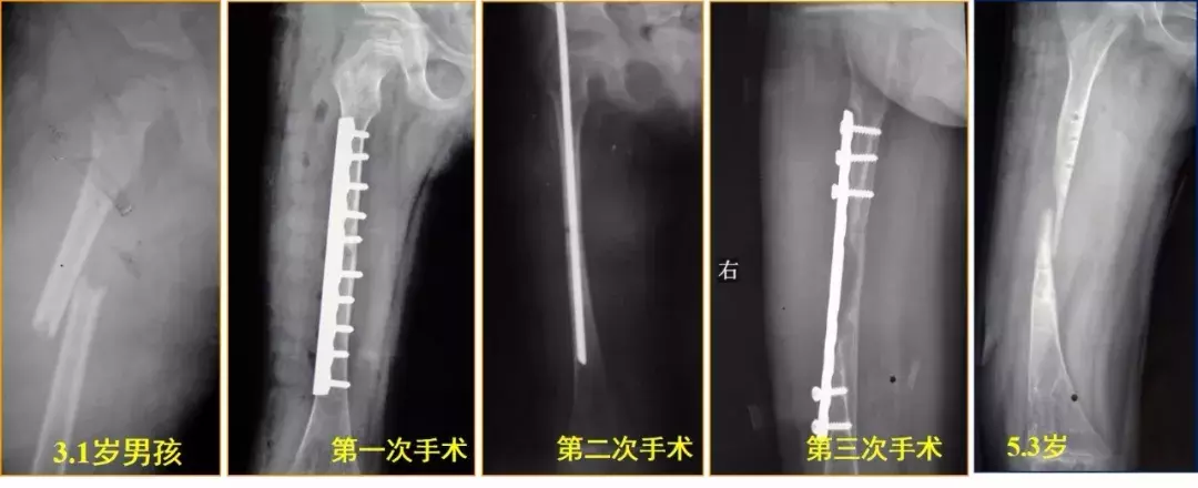 两个儿童股骨干骨折争议病例