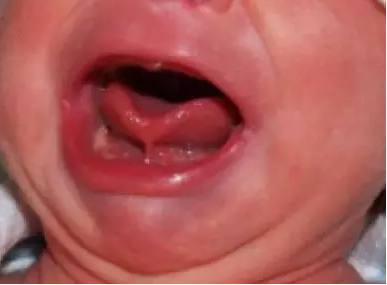 宝宝说话口齿不清？可能是宝宝舌头这里有问题！