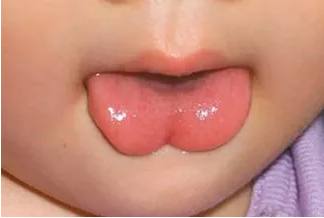 宝宝说话口齿不清？可能是宝宝舌头这里有问题！