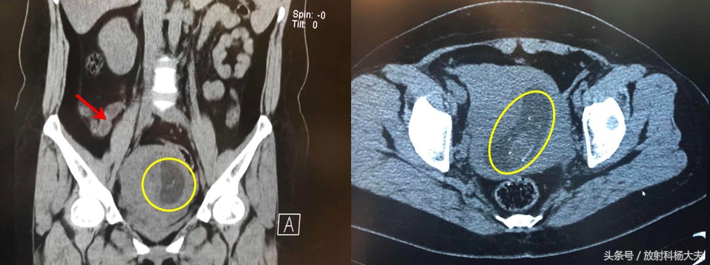 糟了，做腹部CT的那个女病人怀孕了，放射科大夫：没那么糟