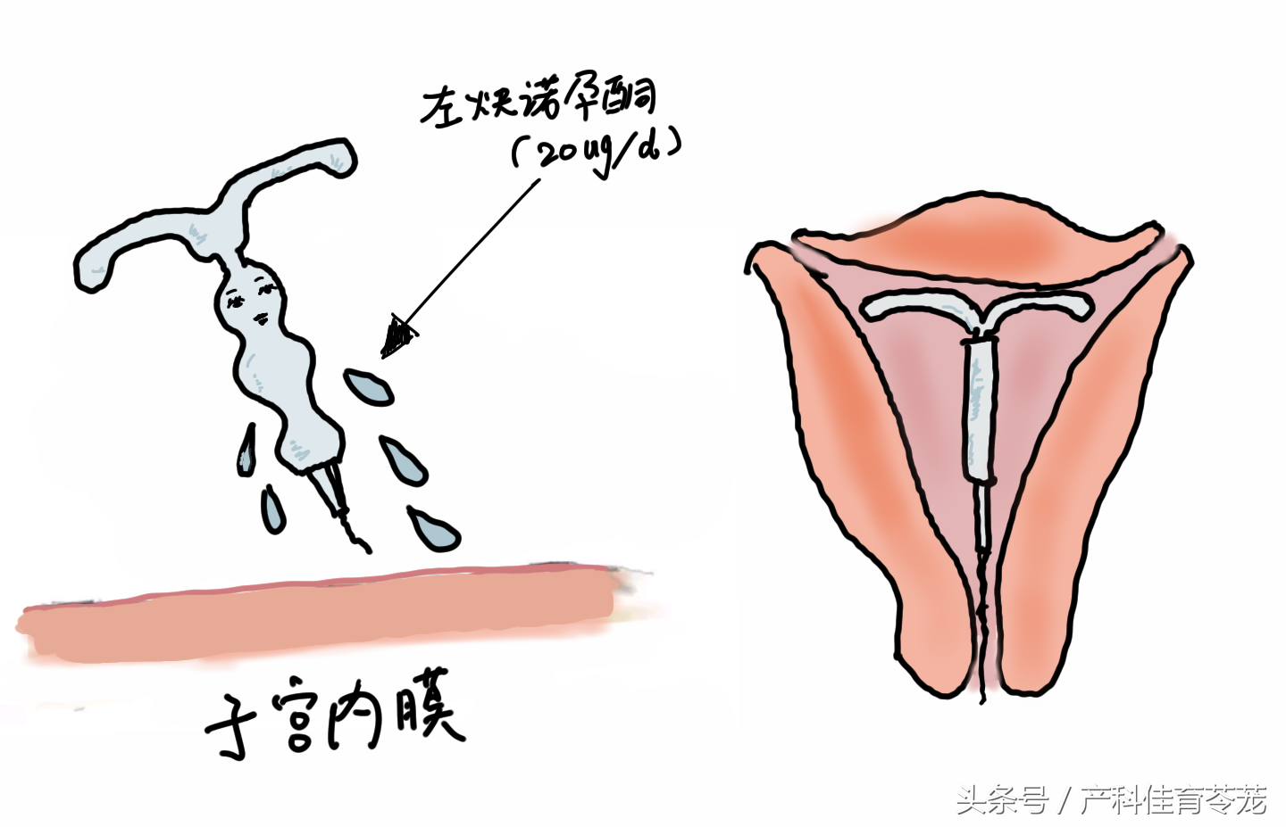 曼月乐环，可不只是避孕那么简单