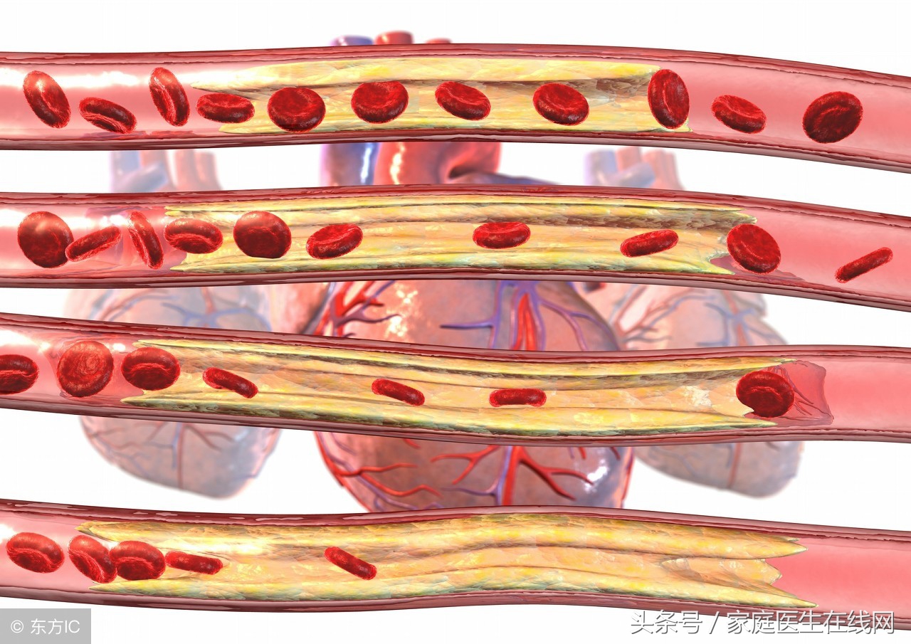 动脉硬化吃什么好（多吃这3种食物血管有弹性）