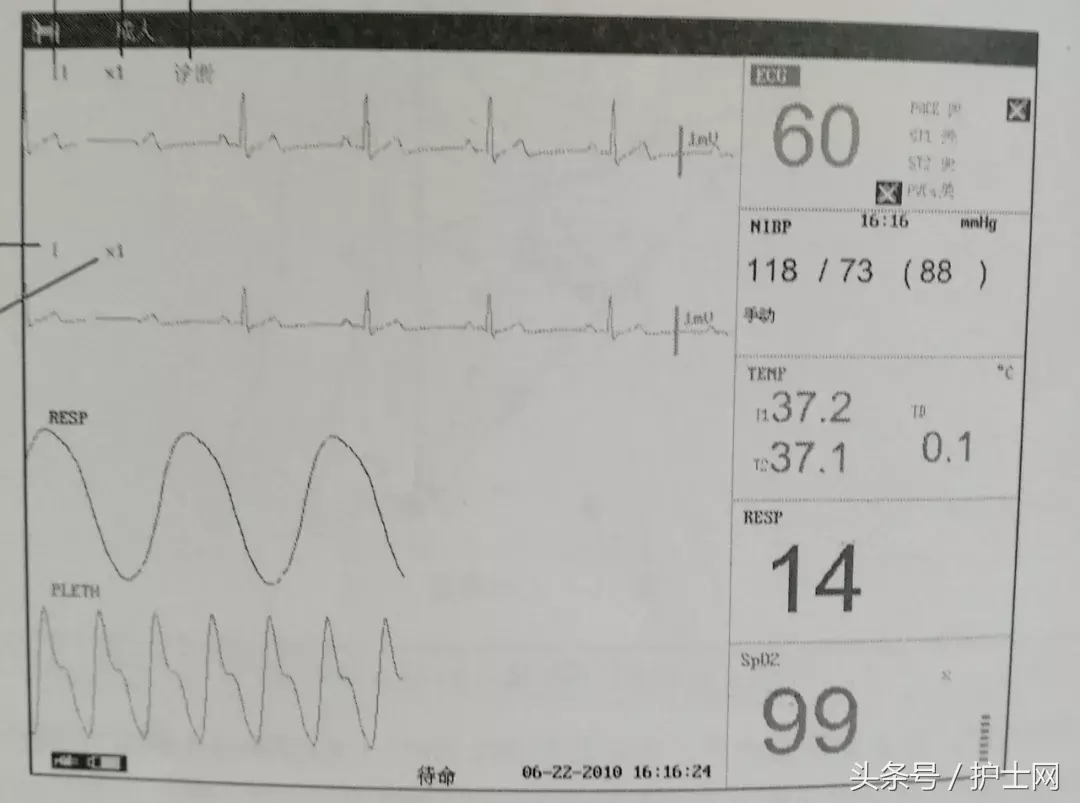心电监护仪上的这个数值你认识吗？