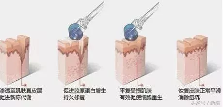 能祛斑祛痘去皱纹?微针到底是护肤扛把子还是装X王?