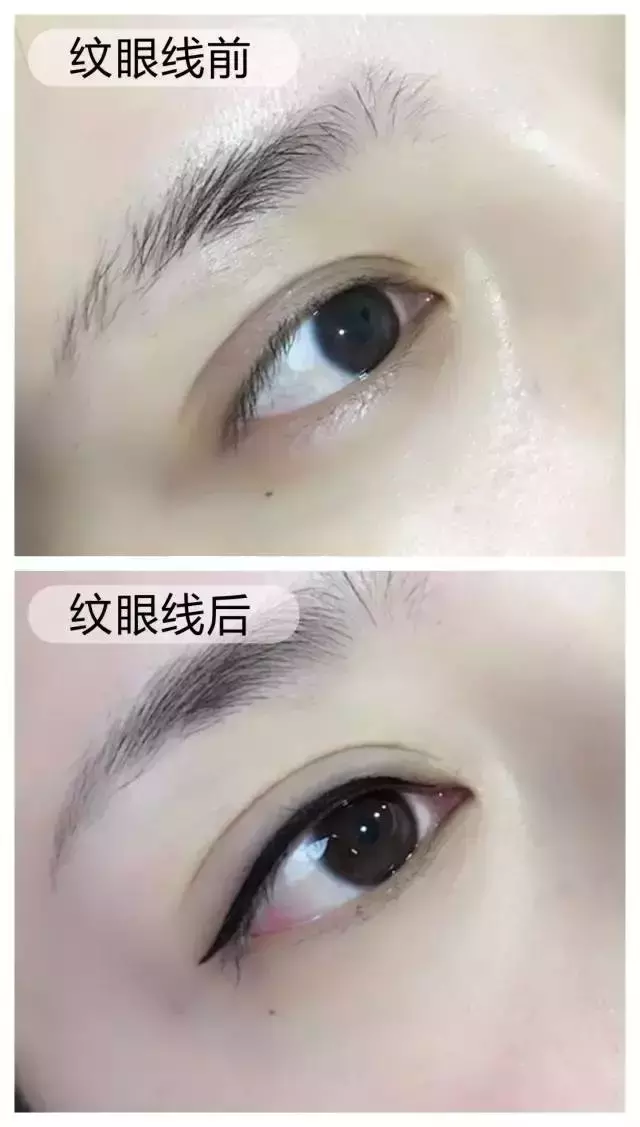 杭州一20多岁时髦小伙上午做完韩式美瞳线,下午就进了医院