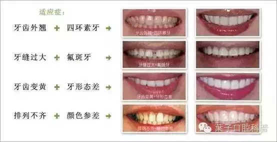 能让牙齿快速变美的牙贴面,是否适合你?葉子口腔科普