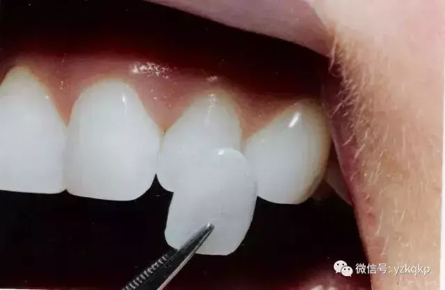 能让牙齿快速变美的牙贴面,是否适合你?葉子口腔科普