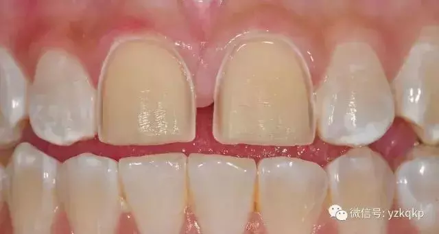 能让牙齿快速变美的牙贴面，是否适合你？葉子口腔科普