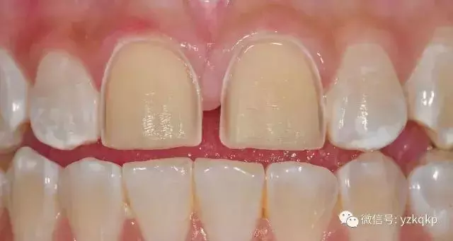 能让牙齿快速变美的牙贴面,是否适合你?葉子口腔科普