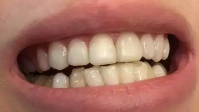 能让牙齿快速变美的牙贴面,是否适合你?葉子口腔科普