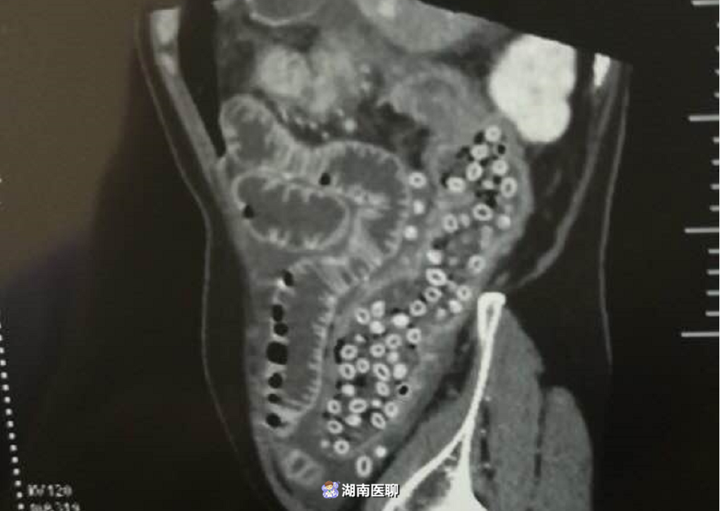 湖南老汉吃杨梅吞核，导致肠穿孔，杨梅核“漏到”腹腔