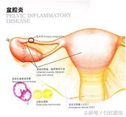 抗菌世界杯款(老公只顾着看“世界杯”，二胎妈妈累出了“盆腔炎”!)