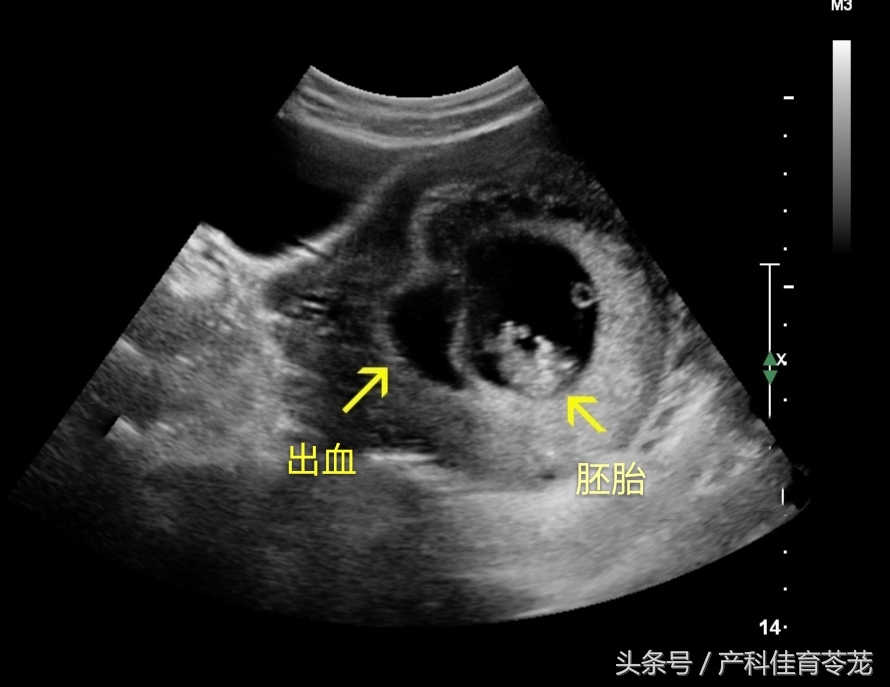 怀孕期间宫腔积血的原因及处理方法