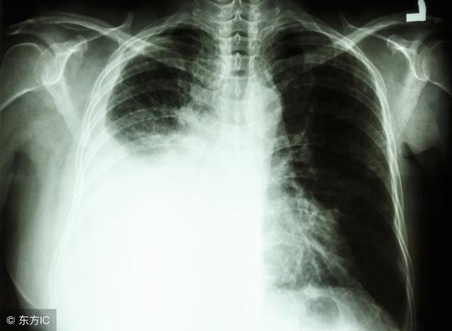 周围型肺癌,周围型肺癌治愈率高吗
