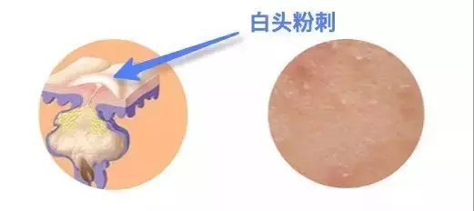 你也有“闭口”噩梦吗?手把手教你去除烦人的闭口!