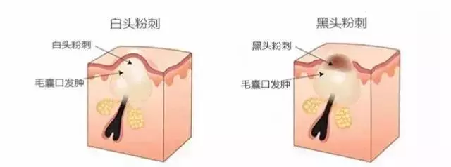 你也有“闭口”噩梦吗?手把手教你去除烦人的闭口!