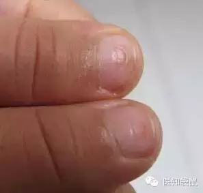 宝宝指甲透露出健康状况！长倒刺、有凹痕要警惕这些病！
