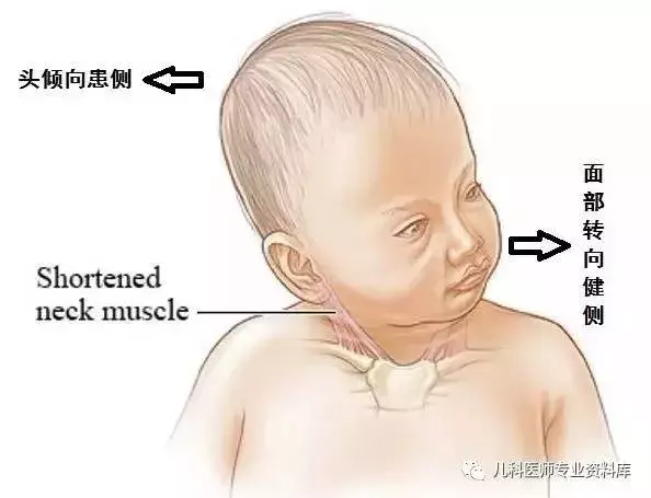 歪脖子,宝宝越小治愈率越高,图解从诊断到治疗方法等你来拿